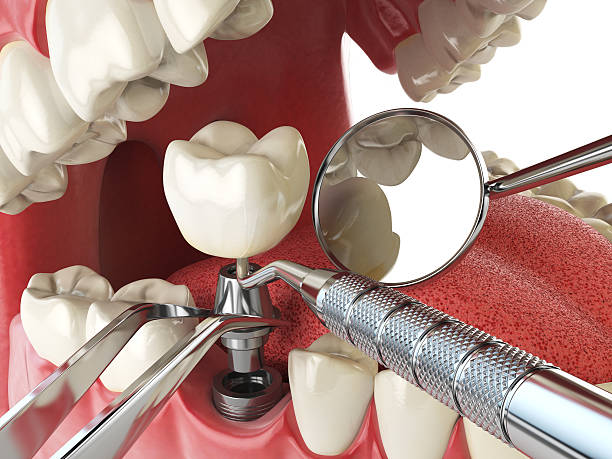 Best Emergency Tooth Extraction in Plainview, NY